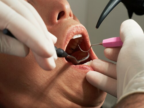 How to Find the Best Dental Implant Specialist in Annerley